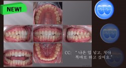 교정 Case 1325. U5L4 발치, 비대칭 Condylar Head, Protrusion, Sem #12.3