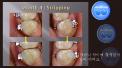 교정 Case 1400. 재교정, Posterior Loose Contact Problems, Root Resorption, Sem #6