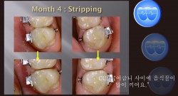 교정 Case 1400. 재교정, Posterior Loose Contact Problems, Root Resorption, Sem #6