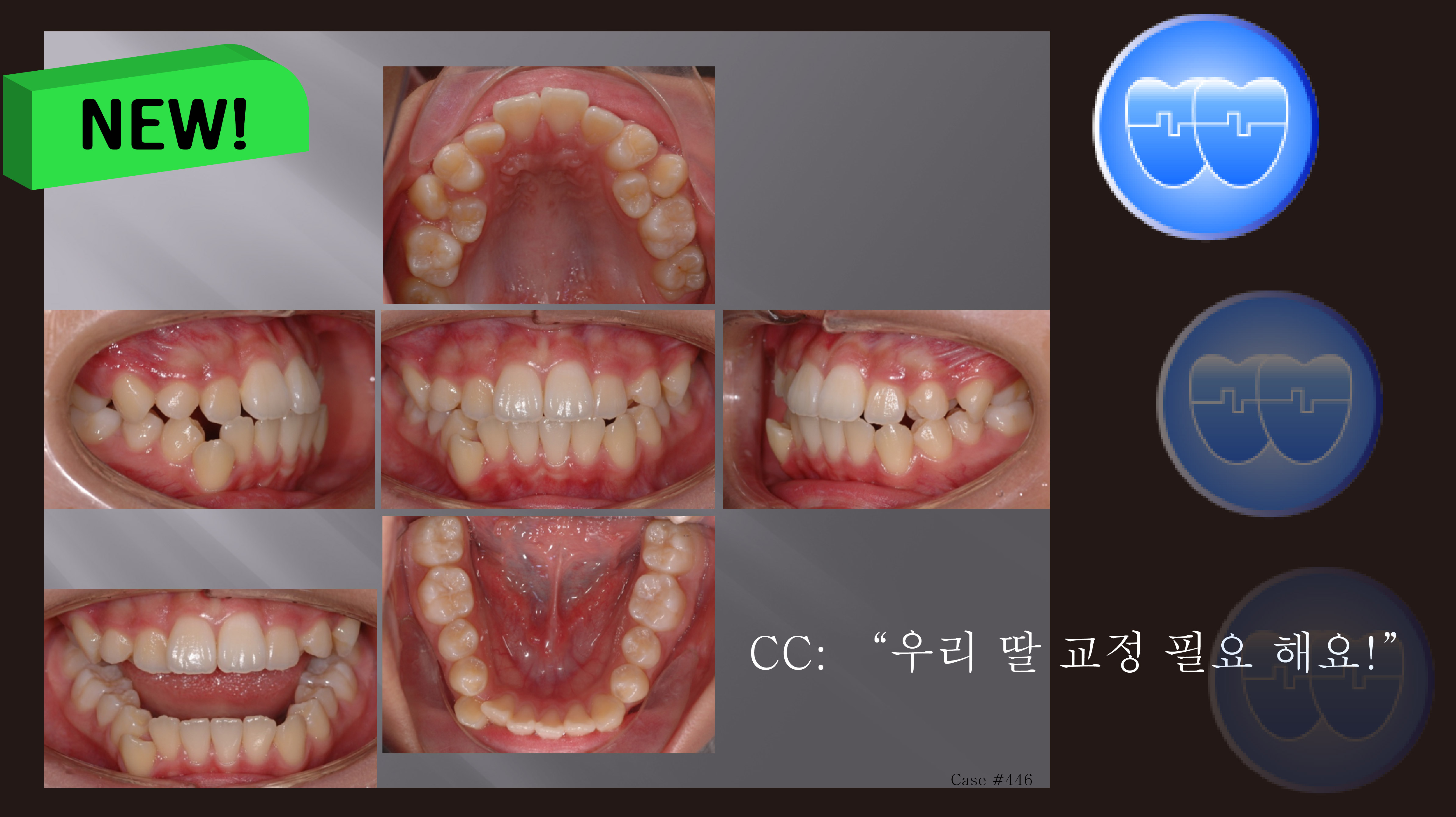 교정 Case 446. Ectopic Eruption, Unusual Extraction, Lower Canine 발치 Sem #13.0