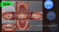 교정 Case 446. Ectopic Eruption, Unusual Extraction, Lower Canine 발치 Sem #13.0