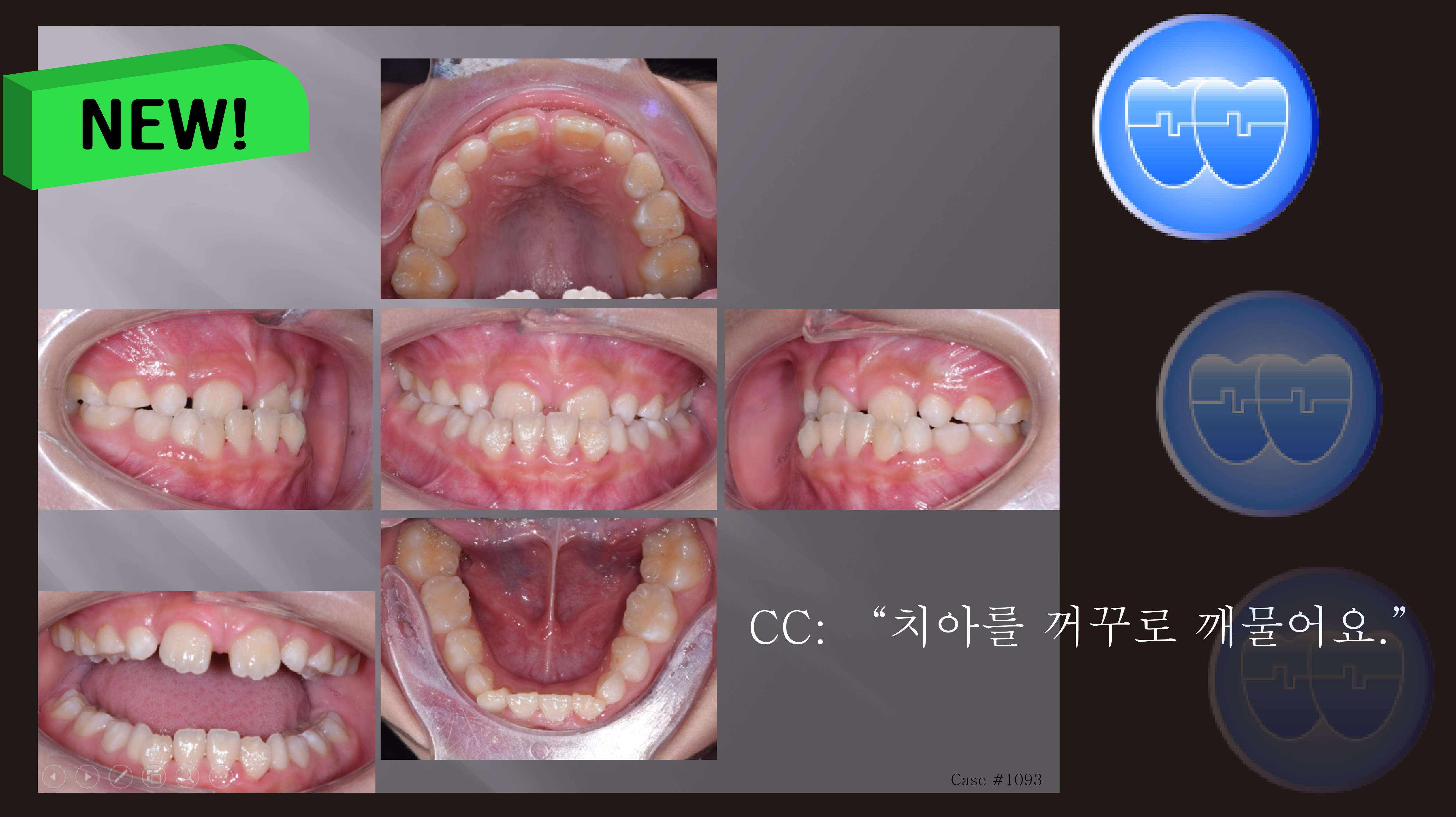 교정 Case 1093(1). 1차 교정, Reverse Pull Headgear, Anterior Crossbite, Sem #9