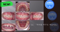 교정 Case 1093(1). 1차 교정, Reverse Pull Headgear, Anterior Crossbite, Sem #9