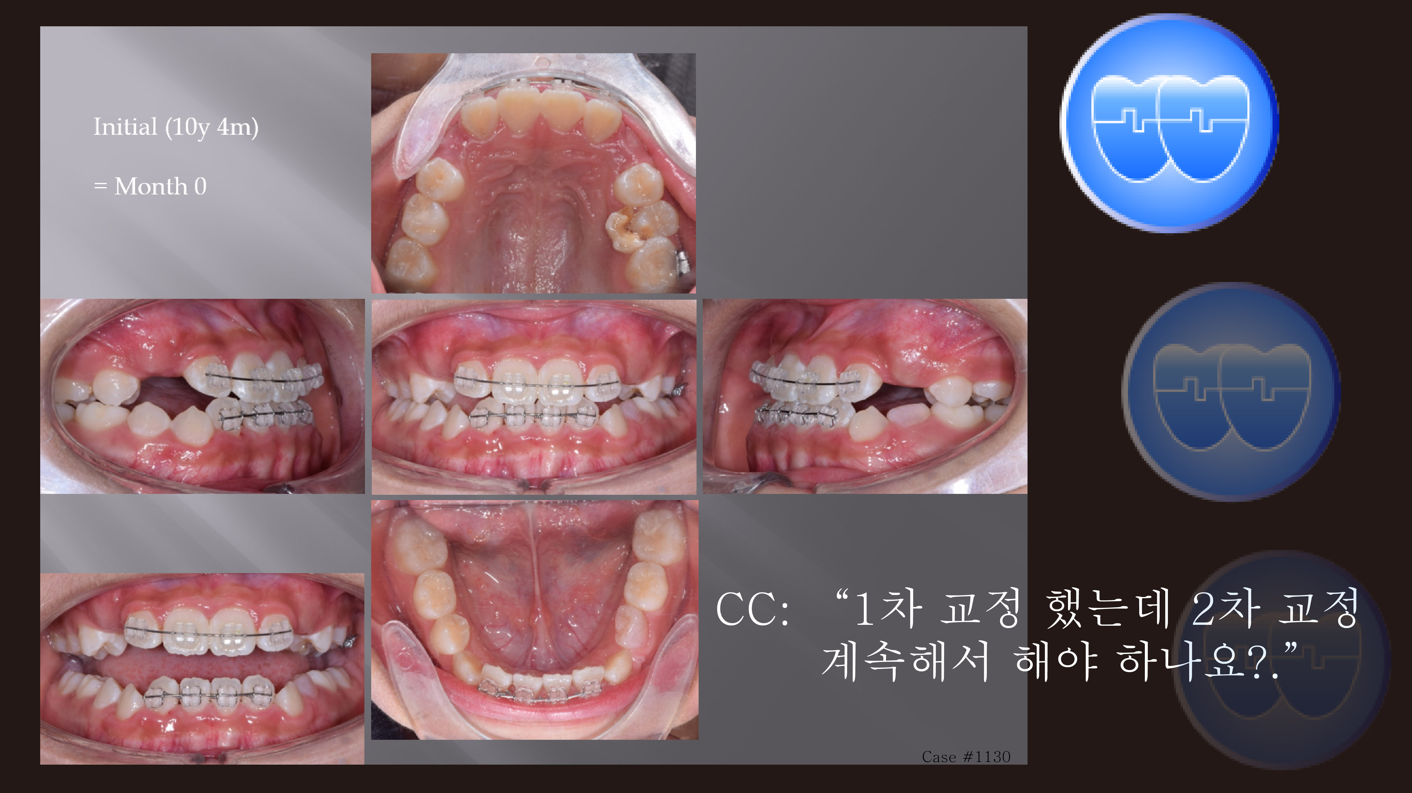 교정 Case 1130. 비발치, Class III, Functional Shift의 변화, 1차교정에서 (교정 Case 858) 연결, Sem #9