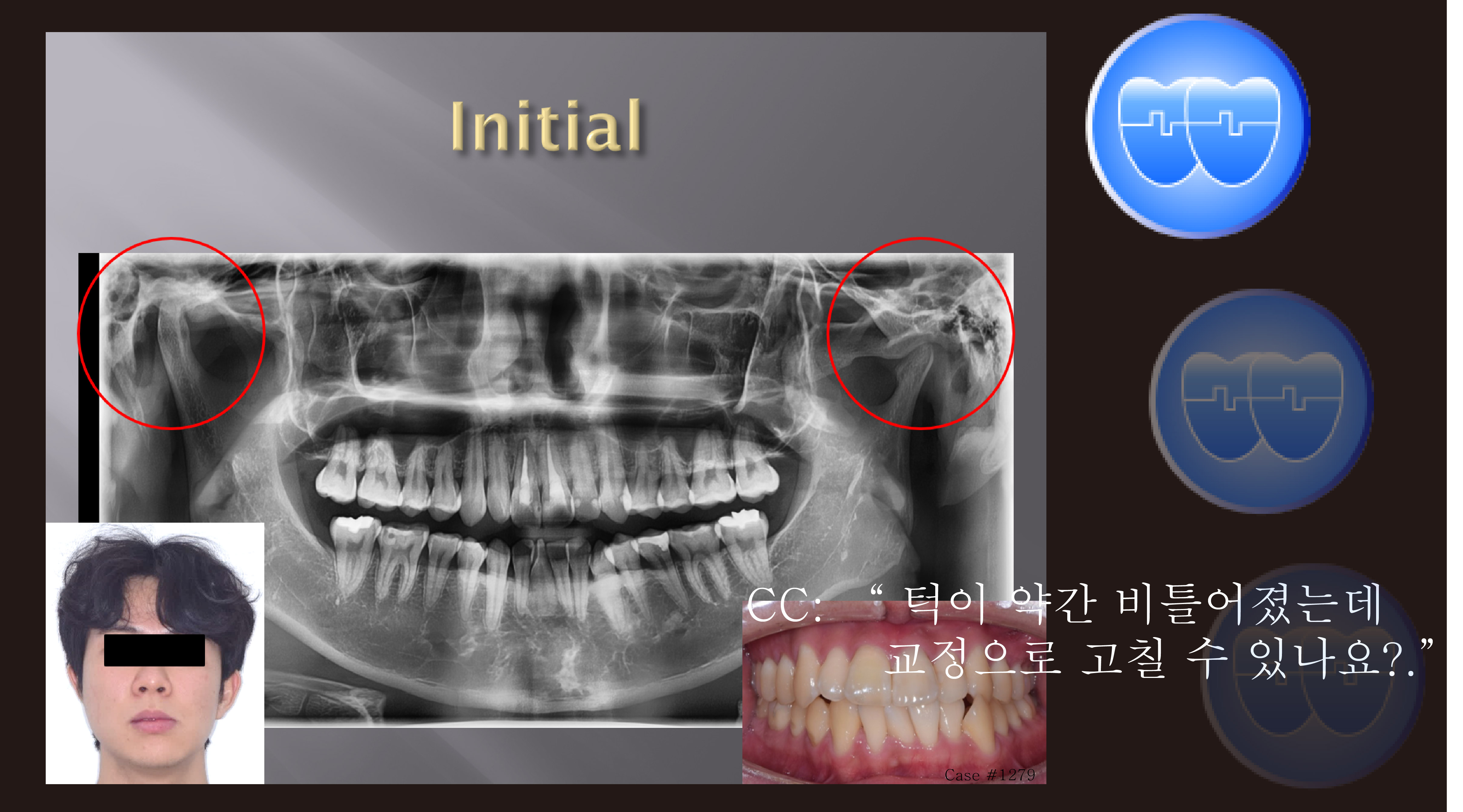 교정 Case 1279. L1 발치, Tilted Occlusal Table, 비대칭 Condylar Head, Sem #19