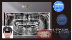 교정 Case 1279. L1 발치, Tilted Occlusal Table, 비대칭 Condylar Head, Sem #19