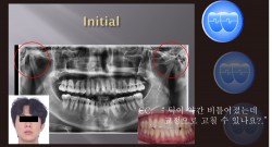 교정 Case 1279. L1 발치, Tilted Occlusal Table, 비대칭 Condylar Head, Sem #19