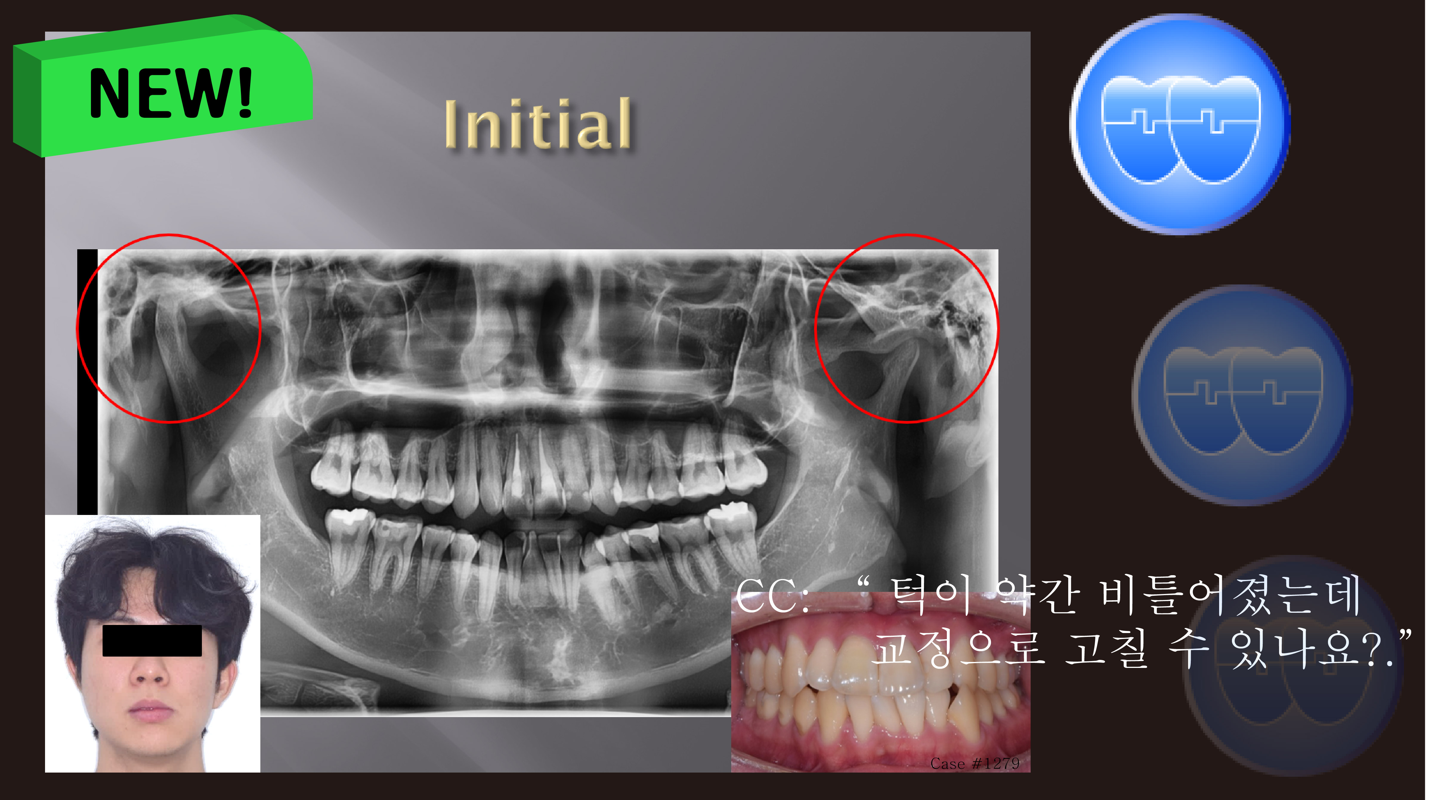 교정 Case 1279. L1 발치, Tilted Occlusal Table, 비대칭 Condylar Head, Sem #19