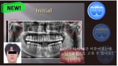 교정 Case 1279. L1 발치, Tilted Occlusal Table, 비대칭 Condylar Head, Sem #19