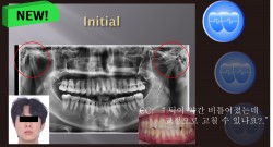 교정 Case 1279. L1 발치, Tilted Occlusal Table, 비대칭 Condylar Head, Sem #19