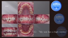 교정 Case 1371. 비발치, High Canine, Arch Expansion, Severe Crowding, Sem #2