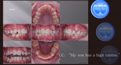 교정 Case 1371. 비발치, High Canine, Arch Expansion, Severe Crowding, Sem #2