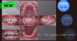 교정 Case 1371. 비발치, High Canine, Arch Expansion, Severe Crowding, Sem #2