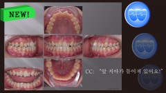 교정 Case 1372. 비발치, Anterior and Posterior Crossbite, Rotation of Anter. Teeth, Sem #16