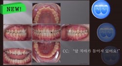 교정 Case 1372. 비발치, Anterior and Posterior Crossbite, Rotation of Anter. Teeth, Sem #16
