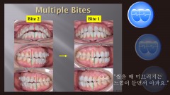 교정 Case 1431. Unstable Occlusion, Possible Anterior Functional Shift, 성인교정, Sem # 19