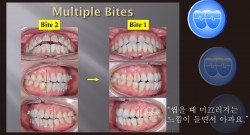 교정 Case 1431. Unstable Occlusion, Possible Anterior Functional Shift, 성인교정, Sem # 19