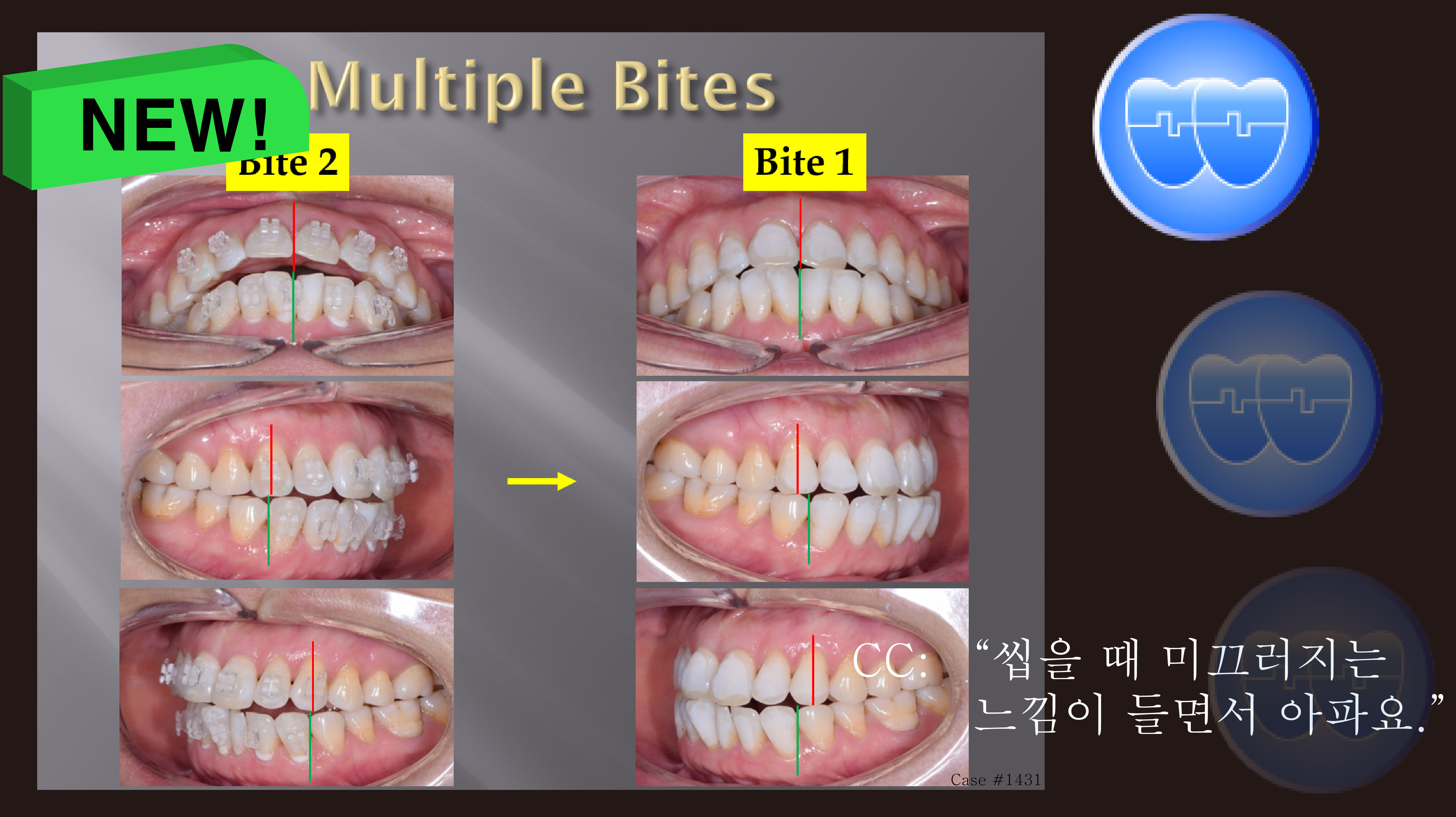 교정 Case 1431. Unstable Occlusion, Possible Anterior Functional Shift, 성인교정, Sem # 19