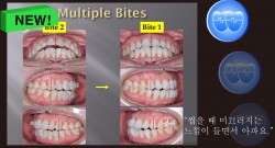 교정 Case 1431. Unstable Occlusion, Possible Anterior Functional Shift, 성인교정, Sem # 19